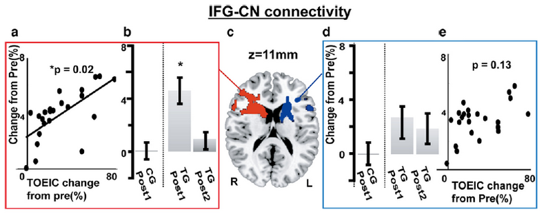 脳の尾状核と右の前頭前野を結んでいる白質の神経線維が太く変化していることを示す写真